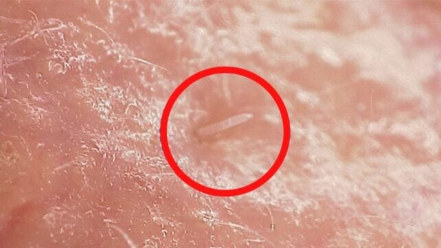 Mites Live on Your Face, And They're Starting to Merge With Humans