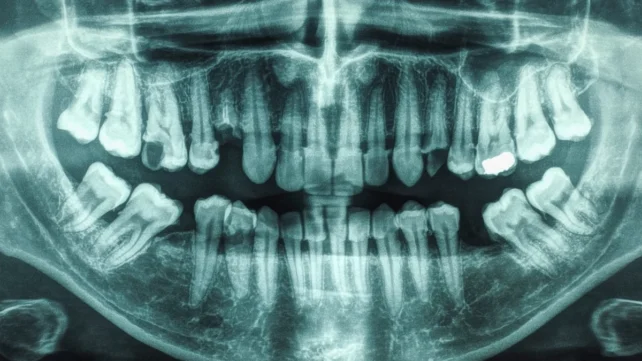 One Specific Diet Reduces Gum Disease in 6-Month Trial