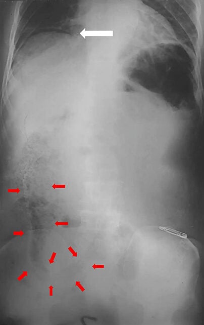 Abdomen X-ray