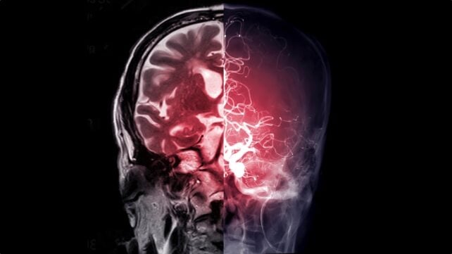 Diabetes Drug Used For More Than 60 Years Found to Unexpectedly Affect The Brain