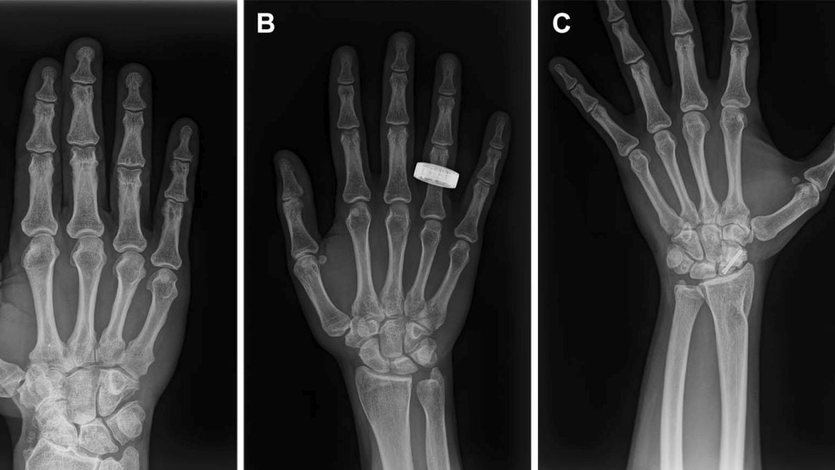 Astronauts take first human X-rays in space — and they worked
