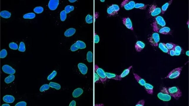Alzheimer's Has Been Killing Brain Cells in a Way Scientists Have Never Understood &ndash; Until Now