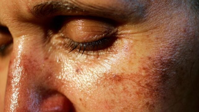 An Illegal Injectable Tanning Drug Is Trending on TikTok &ndash; And It's Giving People Dangerous Moles