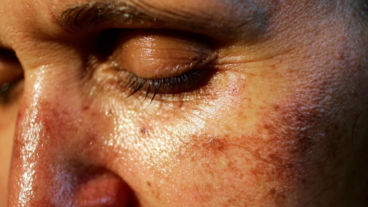Dermatolodzy alarmują: zastrzykowe opalacze są groźne — influencerzy przemilczają ryzyko