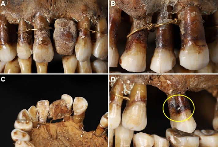 This 17th-Century Aristocrat Had an Ingenious Secret For Keeping Her Teeth