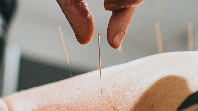 Physio performing acupuncture