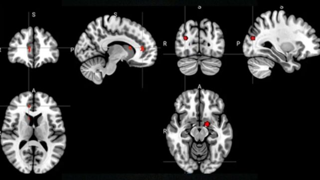 Acupuncture Seems to Rewire The Brain in Depression, Scans Reveal