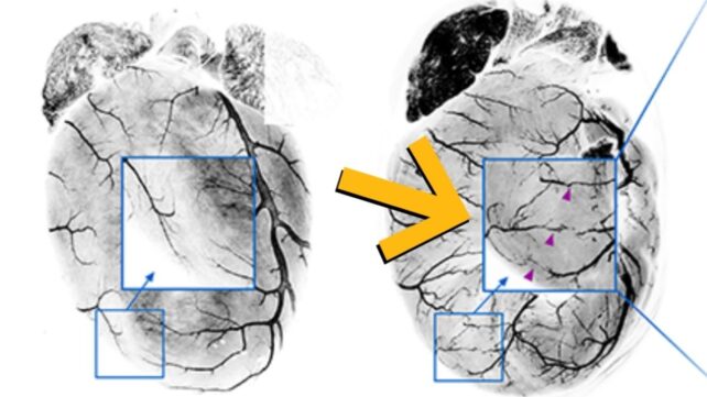 Your Heart Can Actually Build Its Own Bypass After a Heart Attack