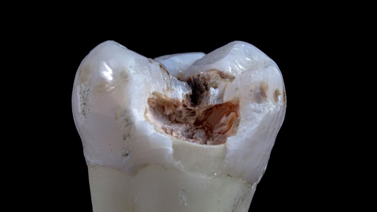 Desetisekundová léčba fluoridem stříbrným může zastavit zubní kaz u dětí bez vrtání