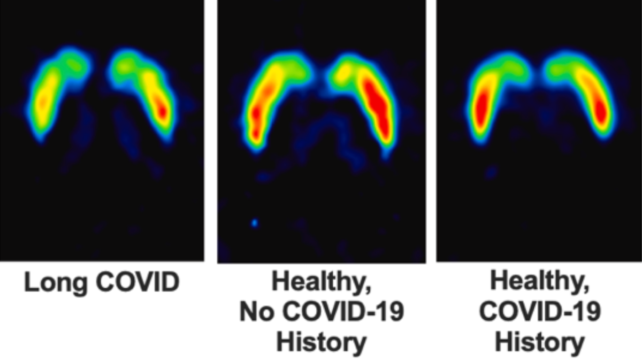 Long COVID Linked to Lasting Damage in The Brain's Dopamine System