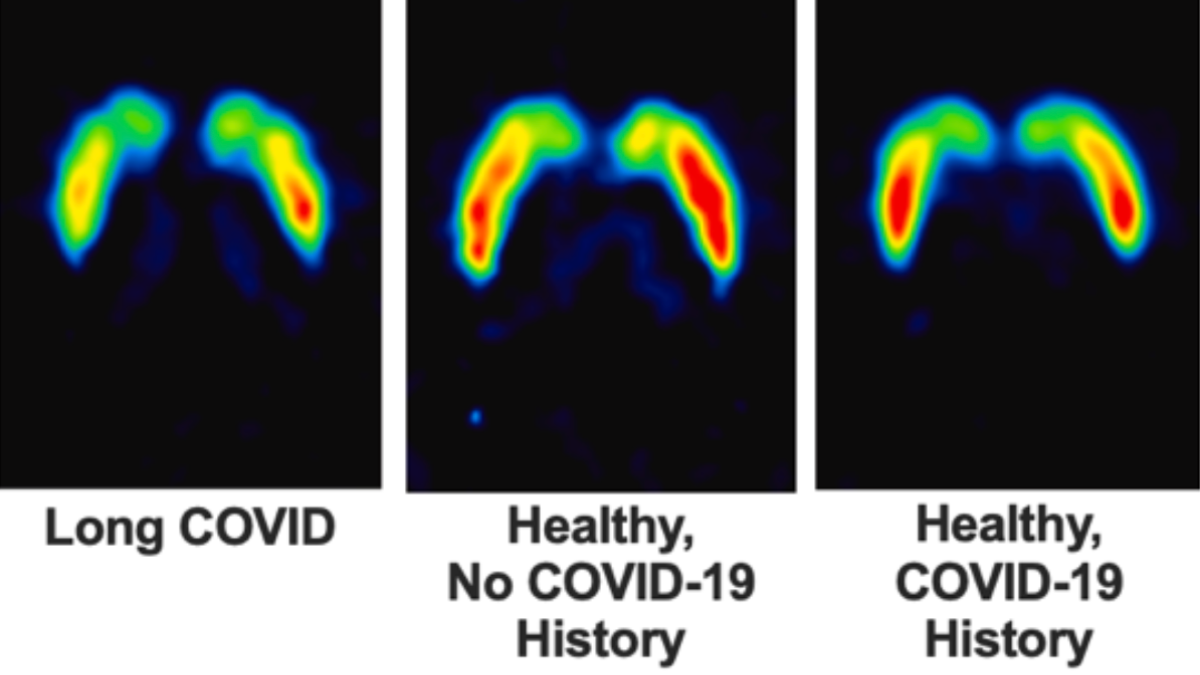 Long COVID Linked to Brain Dopamine Damage and Neurological Symptoms