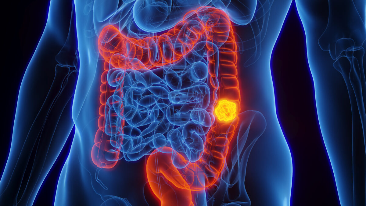 Gut Bacteria May Reveal How a Western Diet Fuels Colon Cancer