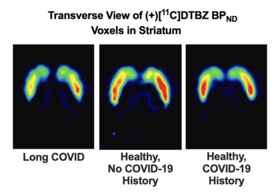 Some People With Long COVID Have Fewer Dopamine Signals in Their Brain
