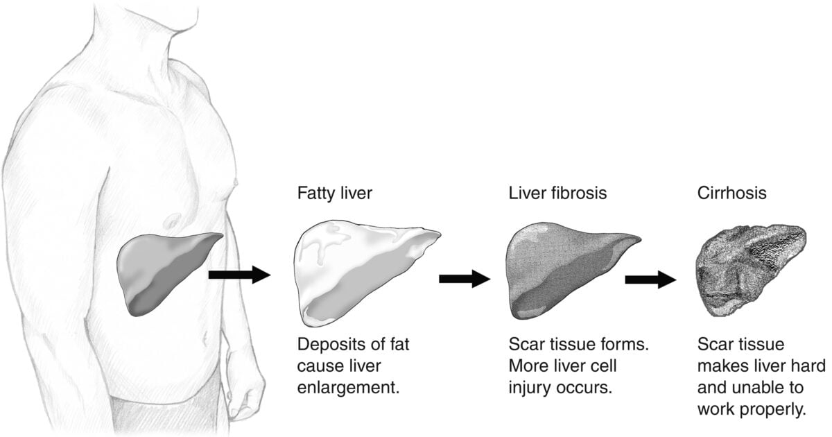 Microplastics Could Be Adding to Your Risk For Fatty Liver Disease