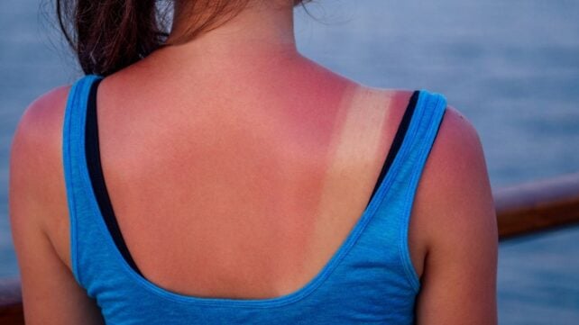 Bad News: Just One Intense Sunburn Really Can Be 'Life-Changing'&nbsp;