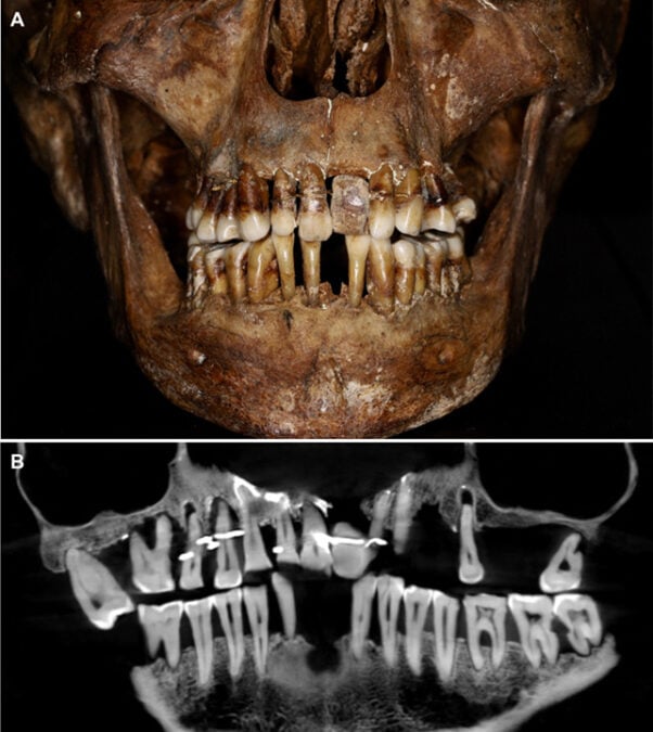 This 17th-Century Aristocrat Had an Ingenious Secret For Keeping Her Teeth