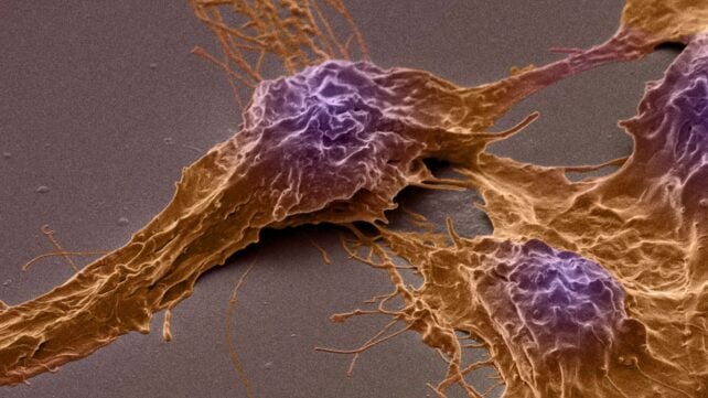 This Deadly Brain Cancer Hijacks Brain Activity to Fuel Its Growth, Study Reveals