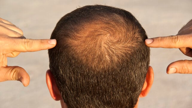 Balding man