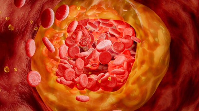 Cholesterol in blood vessels