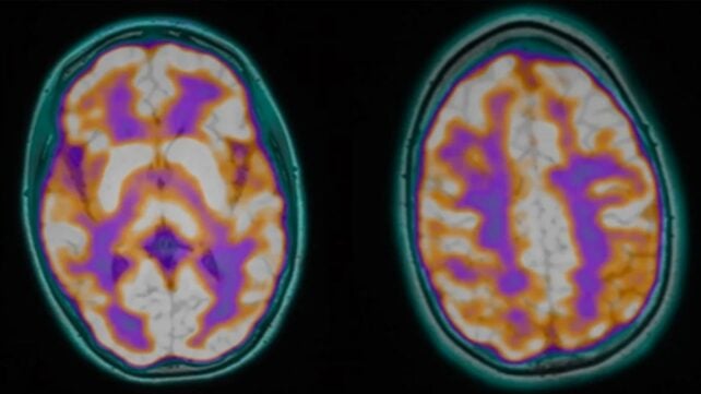 After These Young People Died, Postmortems Found an Unnerving Parasite Link