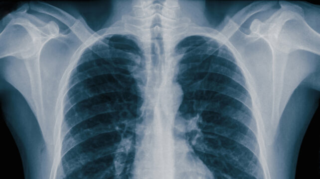 Chest X-ray