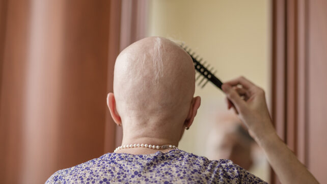 A woman with hair loss