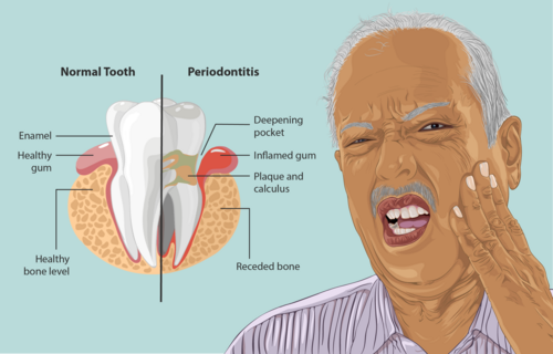 Bleeding Gums Are Linked to a 61% Higher Risk of Alzheimer's, Study Finds