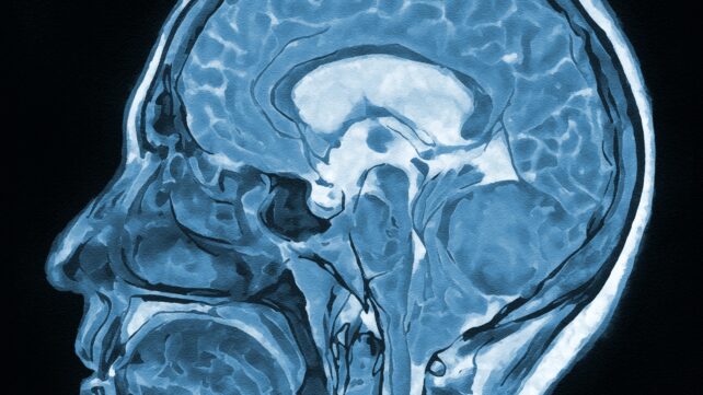 Brain Scans of 24 People With Long COVID Reveal Signs of Injury to Dopamine Neurons