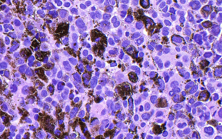 A Common Herbal Supplement May Interfere With Modern Cancer Immunotherapy Treatments