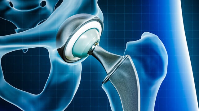 Hip replacement