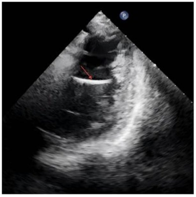 A Man Went to Hospital With Blood in His Urine. Doctors Found a 36-Mm Needle in His Heart