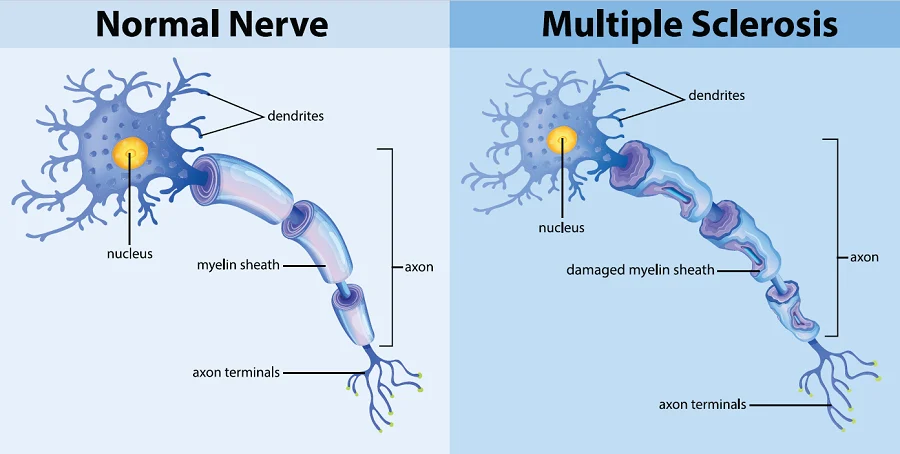 Scientists Map How Reactivated Epstein-Barr Virus Can Trigger Multiple Sclerosis Attacks