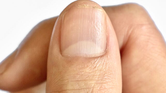 Large lunulae on fingernail