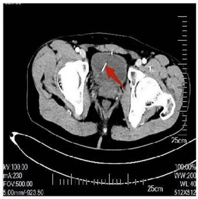 A Man Went to Hospital With Blood in His Urine. Doctors Found a 36-Mm Needle in His Heart