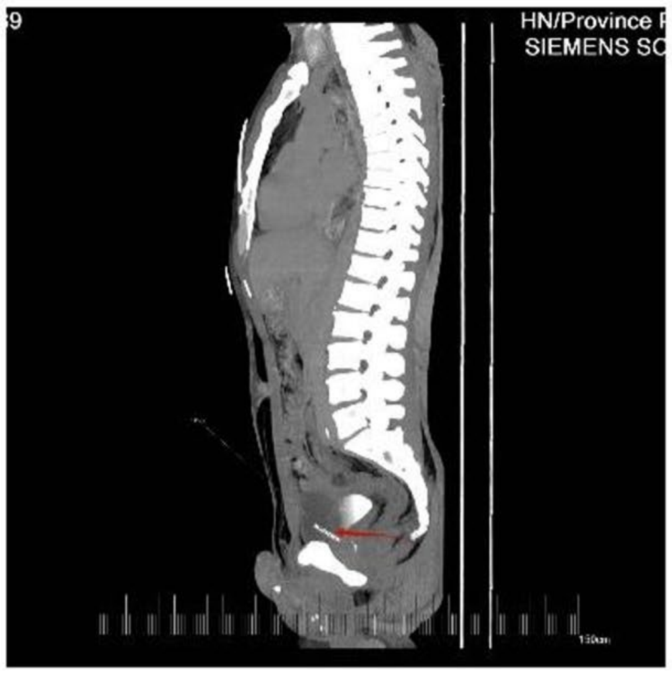 A Man Went to Hospital With Blood in His Urine. Doctors Found a 36-Mm Needle in His Heart