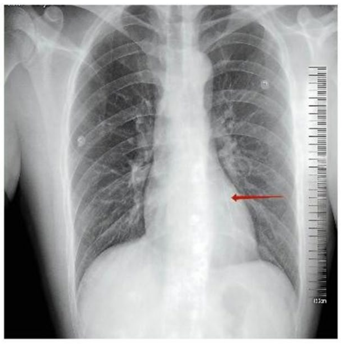 A Man Went to Hospital With Blood in His Urine. Doctors Found a 36-Mm Needle in His Heart