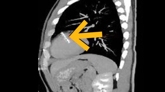A Man Went to Hospital With Blood in His Urine. Doctors Found a Needle in His Heart.