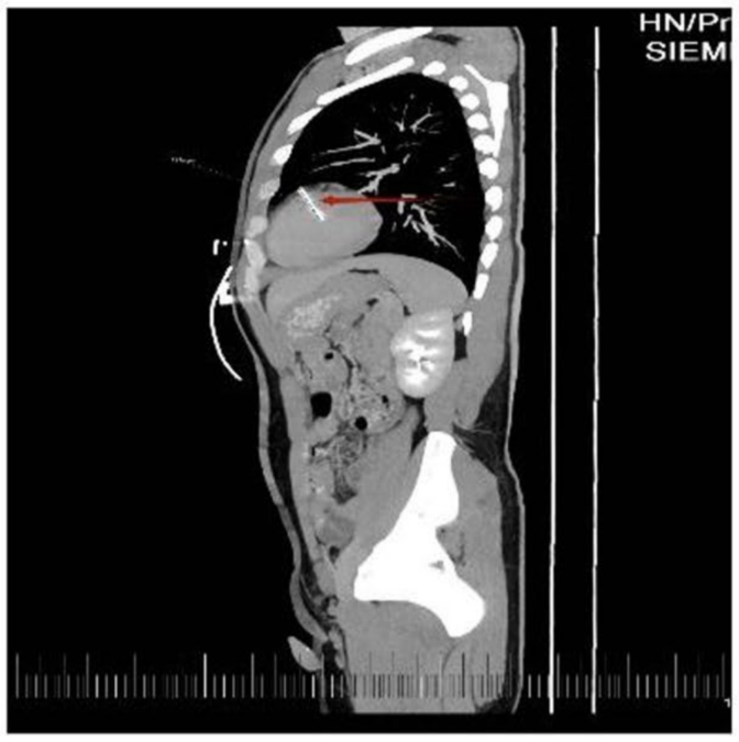A Man Went to Hospital With Blood in His Urine. Doctors Found a 36-Mm Needle in His Heart