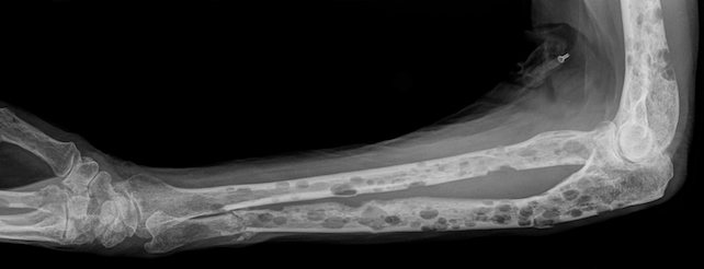 This Drug Can Subdue Pre-Cancerous Bone Marrow Condition, Study Finds