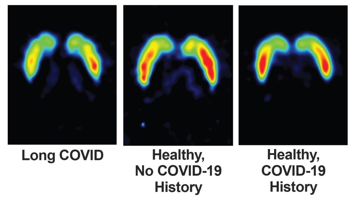Brain Scans of 24 People With Long COVID Suggest Dopamine Neurons May Be Burned Out