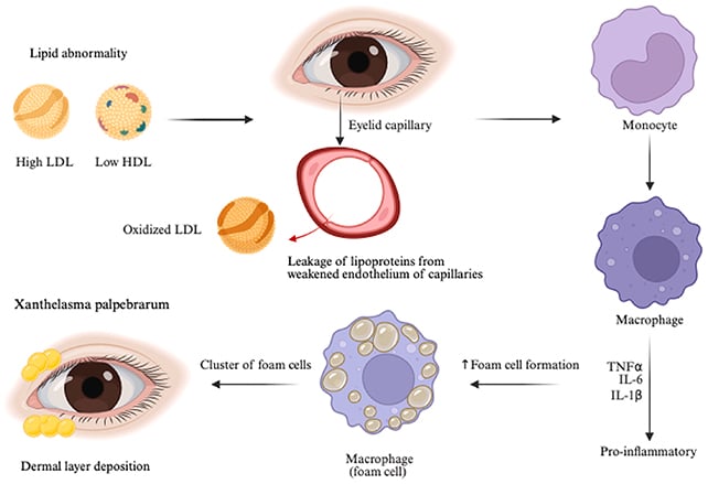 Xanthelasma explainer