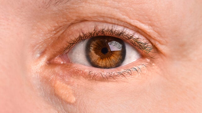Woman's right eye close-up with xanthelasma