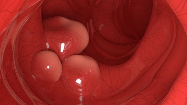 Engineered Probiotic Wipes Out 43% of Colorectal Tumors in Mice