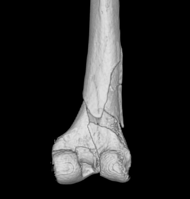 This Medieval Man Had Injuries Like He'd Been Hit by a Train. Scientists Suspect a Trebuchet.