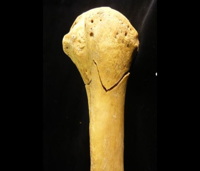This Medieval Man Had Injuries Like He'd Been Hit by a Train. Scientists Suspect a Trebuchet.