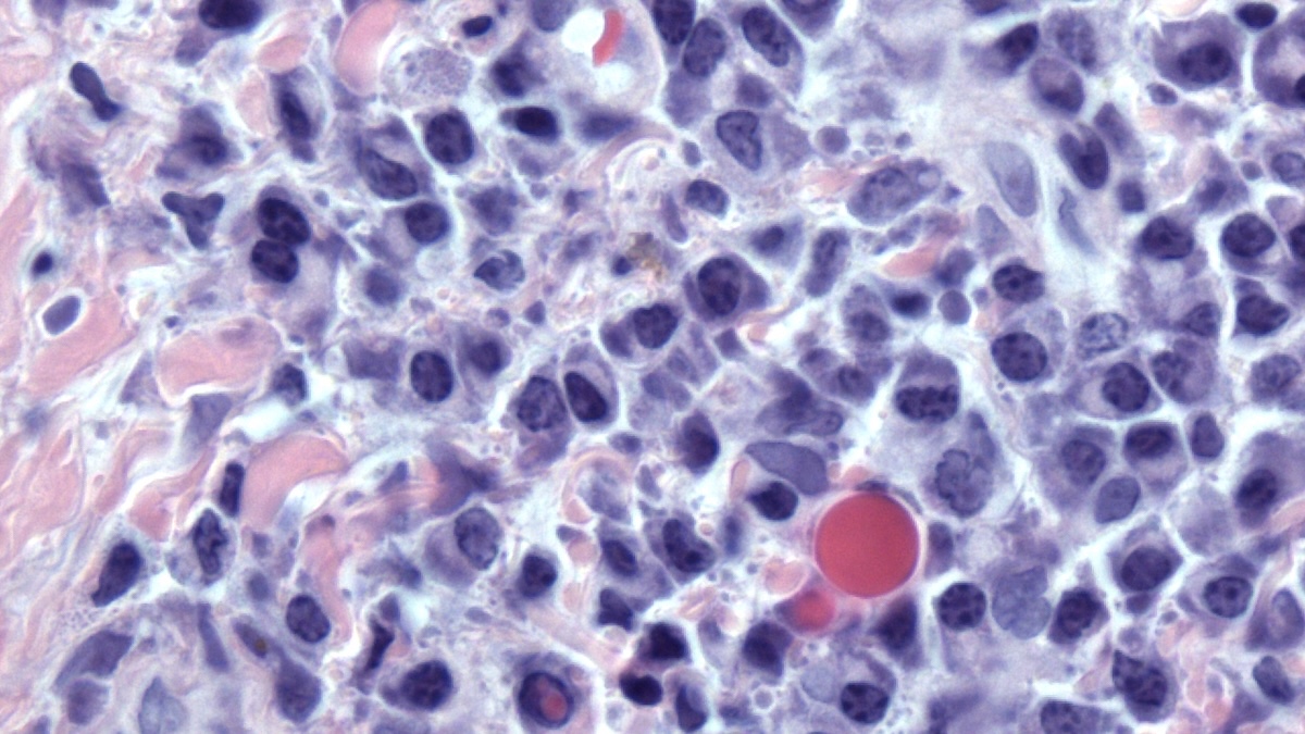 abnormal plasma cells