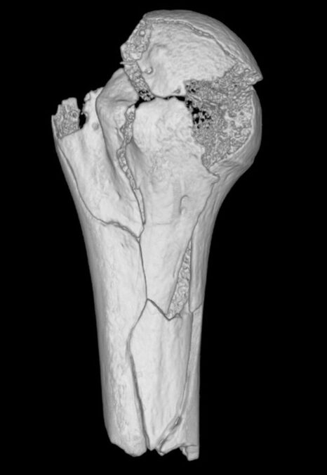 This Medieval Man Had Injuries Like He'd Been Hit by a Train. Scientists Suspect a Trebuchet.