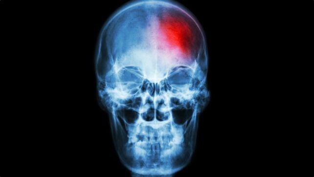A Hidden Source of Chronic Pain May Be Lurking Inside Your Skull, Study Finds