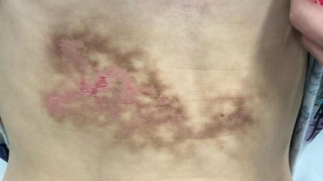 Bizarre Rash Was Thought to Be a Liver Injury, But It Was Caused by a Common Habit
