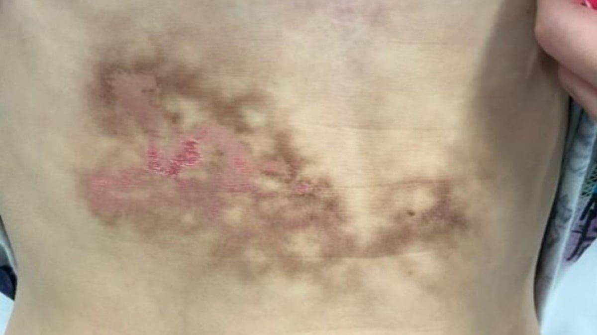 Bizarre Rash Was Thought to Be a Liver Injury, But It Was Caused by a Common Habit
